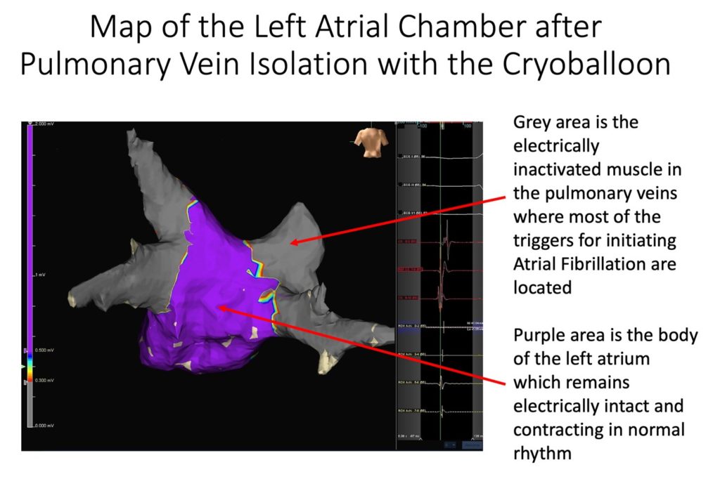 map of left atrial chamber